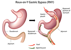 Laparoscopic Gastric By-Pass Delhi