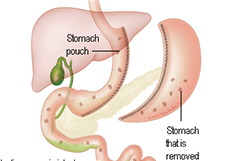 Laparoscopic Sleeve Gastrectomy in Delhi