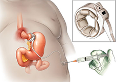 Laparoscopic adjustable gastric banding (LAGB) in Delhi